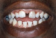 Deryck's Smile Before Porcelain Veneers