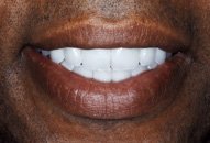 Deryck's Smile After Porcelain Veneers