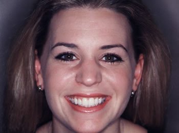 Amy's Porcelain Veneer Smile Makeover