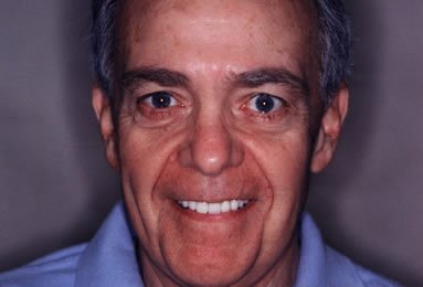 Phil's youthful smile makeover.