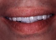 Jose's Smile After Porcelain Veneers
