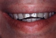 Jose's Smile Before Porcelain Veneers