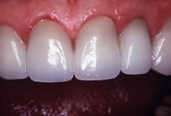 Jose's Tetracycline Stains Invisible with Porcelain Veneers