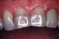 Jose's Tetracycline Stains