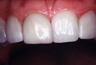 Nikki's Teeth Before