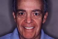 Phil After Porcelain Veneers