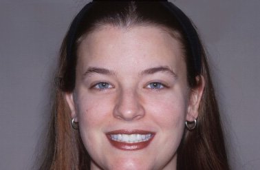 Amy's Beautiful Smile Makeover