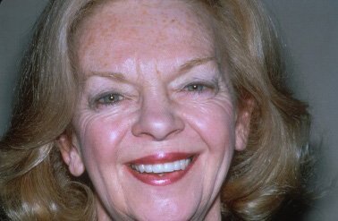 Charlene's Smile Makeover