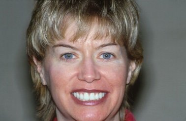 Ellen's Smile Makeover