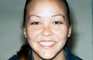 MiMi's Smile Makeover