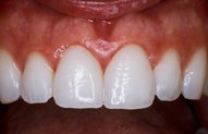 Jayne's Teeth After Porcelain Veneers