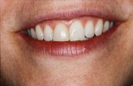 Jayne's Smile Before Porcelain Veneers