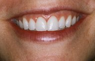 Jayne's Smile After Porcelain Veneers