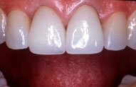 Joann After Porcelain Crowns