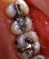 Mercury-containing amalgam fillings