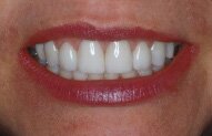 Ellen's Smile After Porcelain Bonding