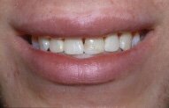 Tim's Smile Before Porcelain Bonding