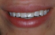 Tim's Smile After Porcelain Bonding