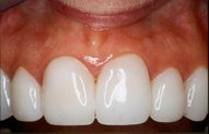 Crooked Teeth After Veneers