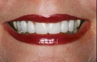 Crooked Teeth Straightened by Veneers