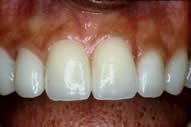 Shoba's Teeth After Veneers