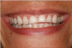 Amanda's teeth before bulimia treatment