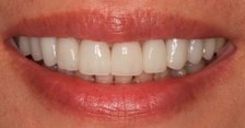 ying-after A smile Dr. Hurley renewed with porcelain veneers.