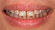 ying-before Porcelain veneers can fix your tetracycline stains