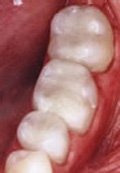 Photo of fillings after being replaced with composite from Bedminister, NJ cosmetic dentist Dr. Allyson Hurley.