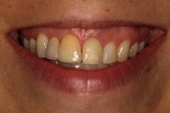 New Jersey dental implants before picture from Dr. Allyson Hurley.