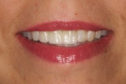 New Jersey dental implants before picture from Dr. Allyson Hurley.