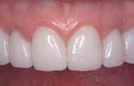 Porcelain crowns and veneers after teeth-only photo Anita from the smile gallery of New Jersey cosmetic dentist Dr. Allyson Hurley.