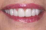 Porcelain crowns and veneers after close-up photo of Anita from the smile gallery of New Jersey cosmetic dentist Dr. Allyson Hurley.