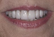 After lips and teeth photo of patient (J) for teeth too big smile makeovers from New Jersey cosmetic dentist Dr. Allyson Hurley.