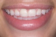 After dental bonding photo of patient (R) from the smile gallery of Bedminster, NJ cosmetic dentist Dr. Allyson Hurley.