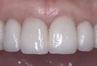 Teeth only after photo of patient (J) for teeth too big smile makeovers from New Jersey cosmetic dentist Dr. Allyson Hurley.