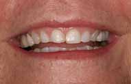 Porcelain crowns and veneers before teeth-only photo Marsha from the smile gallery of New Jersey cosmetic dentist Dr. Allyson Hurley.