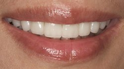 Teeth and lips after photo of patient (Y) for tetracycline stains makeovers in the smile gallery of New Jersey cosmetic dentist Dr. Allyson Hurley.