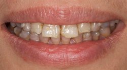 Teeth and lips after photo of patient (Y) for tetracycline stains makeovers in the smile gallery of New Jersey cosmetic dentist Dr. Allyson Hurley.