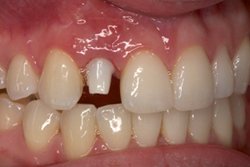 Before photo of patient (L) for missing tooth smile makeovers from New Jersey cosmetic dentist Dr. Allyson Hurley.