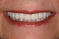 Teeth and lips after photo of patient (L) for dental crowns smile makeovers from New Jersey cosmetic dentist Dr. Allyson Hurley.