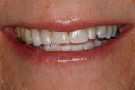 Teeth and lips before photo of patient (L) for dental crowns smile makeovers from New Jersey cosmetic dentist Dr. Allyson Hurley.