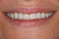 Teeth and lips after photo of patient (Lz) for dental crowns from New Jersey cosmetic dentist Dr. Allyson Hurley.