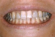 Teeth and lips before photo of patient (Lz) for dental crowns from New Jersey cosmetic dentist Dr. Allyson Hurley.